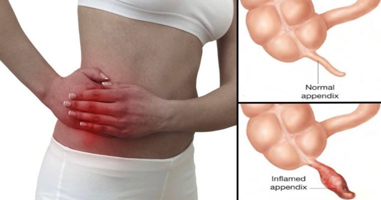 5 warning signs your appendix is about to burst - Doctorbabu
