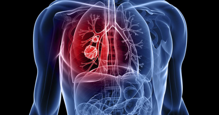 lung cancer