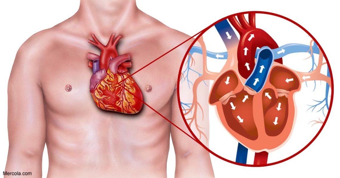 Heart Blockage Treated