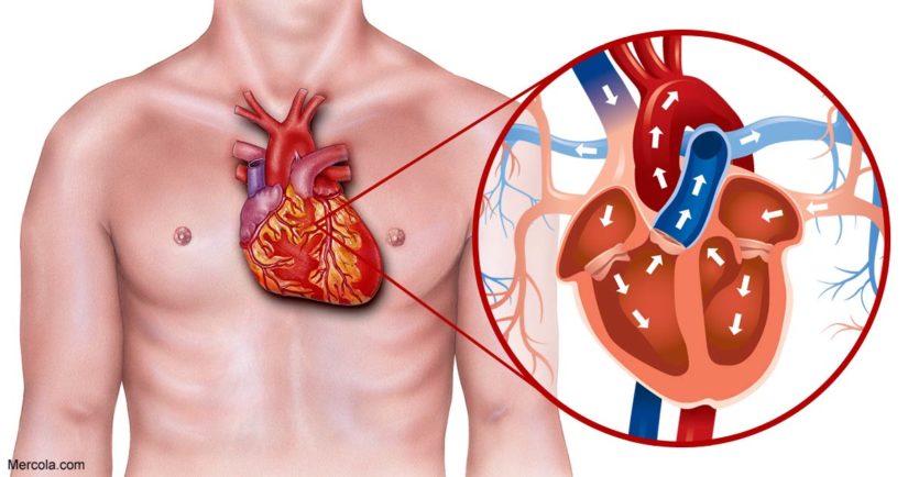 Heart Blockage Treated