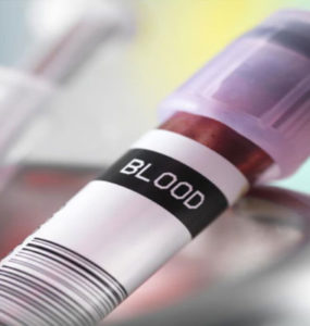 New Blood Test to detect Heart Attack Patients Most at Risk