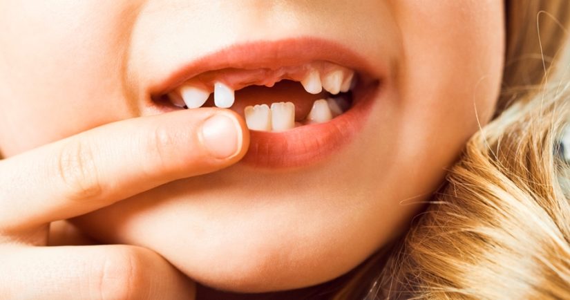 Common Dental Problems in Children