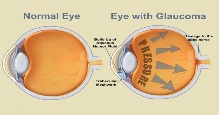 eyes glaucoma